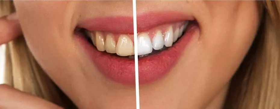 elfbar nachfüll pod läuft aus Est-ce que la cigarette électronique jaunit les dents ?